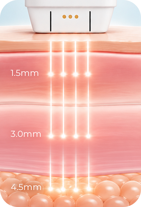 Ultherapy Prime treatment depths