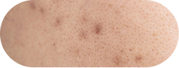 Acne marks (PIH):