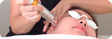 Acne Scar Treatment
