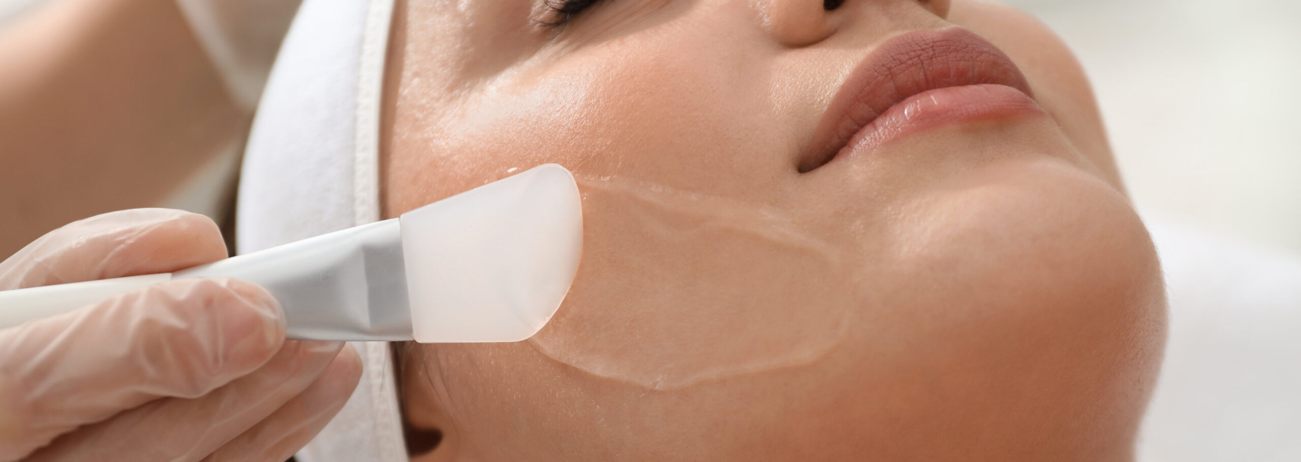Chemical Peel