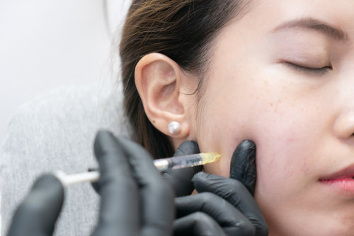 Dermal Fillers