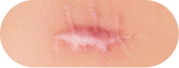 Hypertrophic and keloid scars