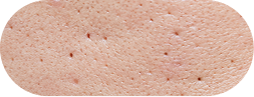 Ice pick scars
